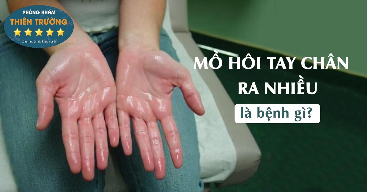 RA MỒ HÔI TAY NHIỀU LÀ BỆNH GÌ? - Da liễu Thiên Trường