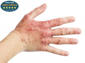 Hình ảnh: Viên da cơ địa.