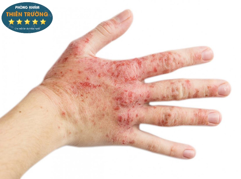 Hình ảnh: Viên da cơ địa.