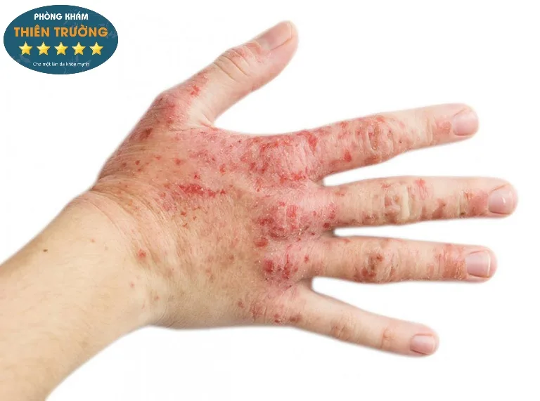 Hình ảnh: Viên da cơ địa.