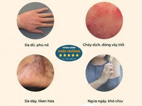 Hình ảnh: Dấu hiệu nhận biết viêm da cơ địa