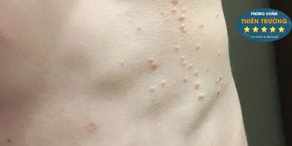 Hình ảnh: U mềm lây lan rộng ra các vùng khác
