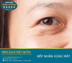 Hình ảnh: Nhăn vùng mắt.