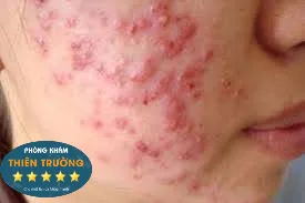 Hình ảnh: Mụn trứng cá.