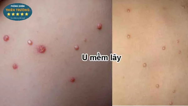 Hình ảnh: Dấu hiệu nhận biết u mềm lây