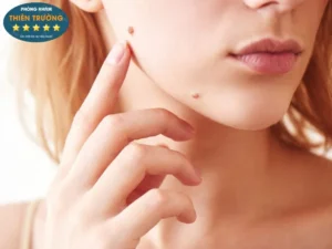 Hình ảnh: Tẩy nốt ruồi