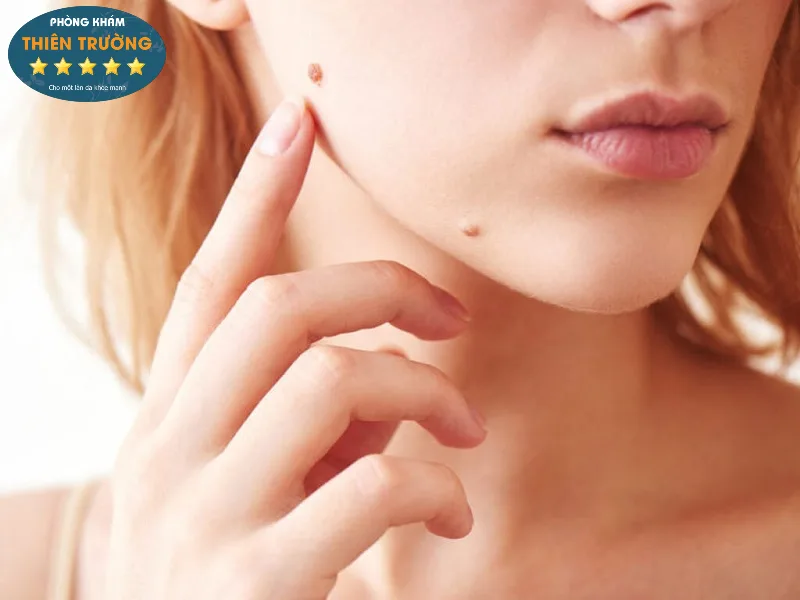 Hình ảnh: Tẩy nốt ruồi