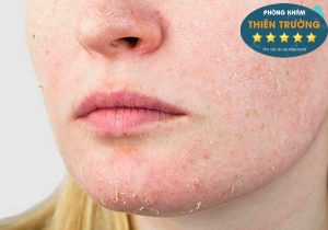 Hình ảnh : Da khô.