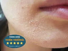 Hình ảnh: Da khô bong vẩy.