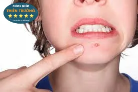 Hình ảnh: Mụn trứng cá.