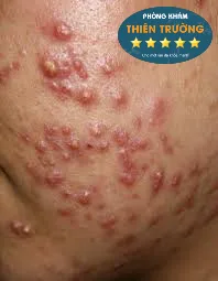 Hình ảnh: Mụn trứng cá nặng.