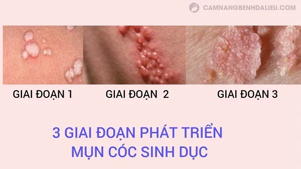 Hình ảnh: Sự phát triển của mụn cóc sinh dục.