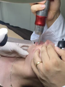 Hình ảnh: Triệt lông râu.