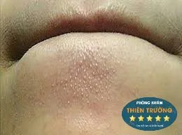 mụn ẩn ở cằm 1