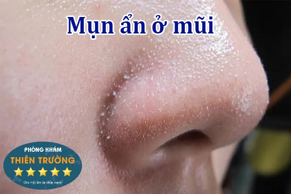 mụn ẩn ở mũi