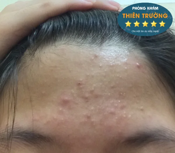 mụn ẩn trên trán