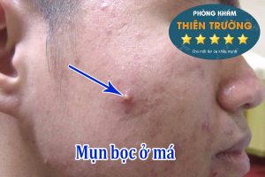 Hình ảnh: Mụn bọc ở má.