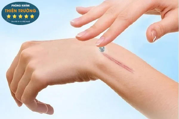 Hình ảnh: Kem trị sẹo lồi có thực sự hiệu quả