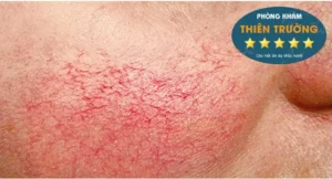 Hình ảnh Giãn mao mạch.