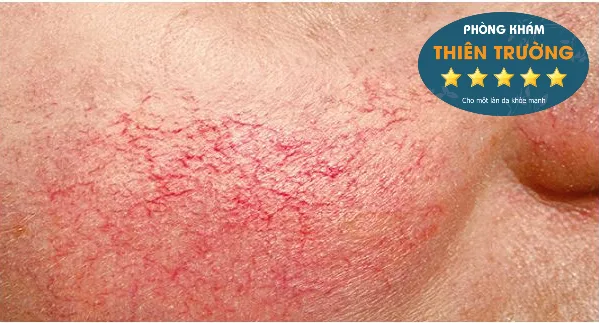 Hình ảnh Giãn mao mạch.