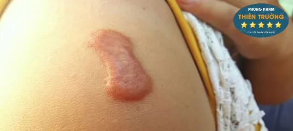 Hình ảnh: Sẹo lồi