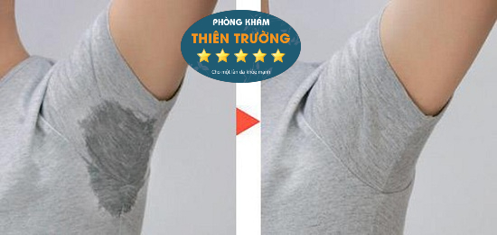 Hình ảnh: Khách hàng sau khi được hỗ trợ điều trị mồ hôi nách.