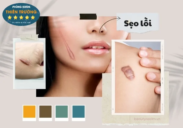Hình ảnh : sẹo lồi
