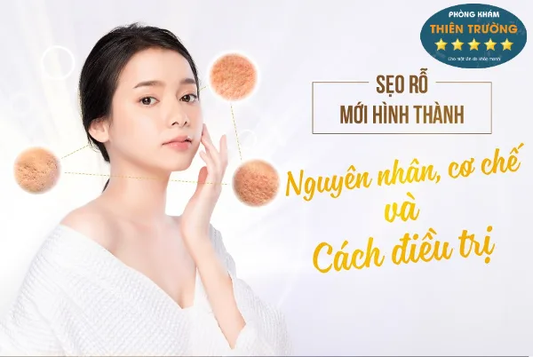seo-ro-moi-hinh-thanh-1