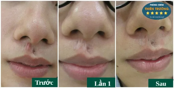 Hình ảnh: Hỗ trợ điều trị sẹo lồi trước và sau điều trị sẹo lồi