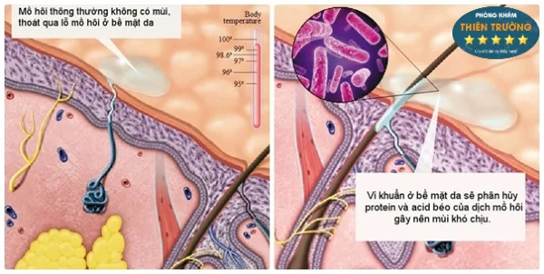 Hình ảnh: Tuyến mồ hôi nách