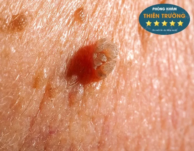 trieu-chung-sui-mao-ga