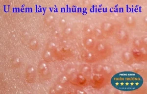Hình ảnh: Triệu chứng U mềm lây