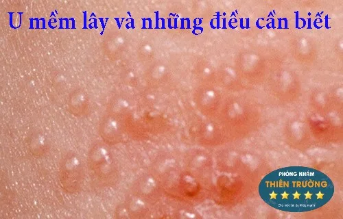 u-mem-lay-duoc