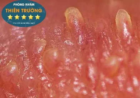 Hình ảnh: Sùi mào gà