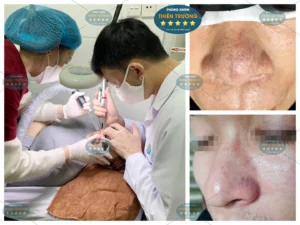 Hình ảnh: Khách hàng bị giãn măo mạch ở mũi.