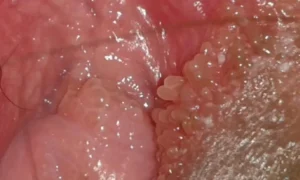 Hình ảnh: sùi mào gà