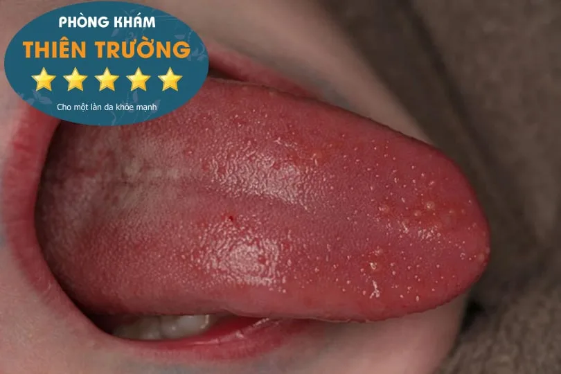 Sùi mào gà ở lưỡi (2)