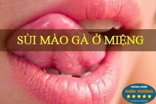 Sùi mào gà ở miệng