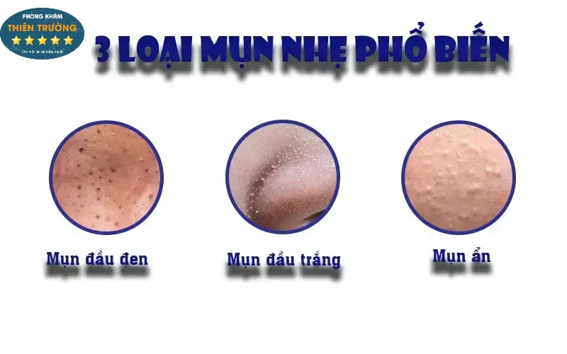 Hình ảnh: Những loại mụn phổ biến trên da