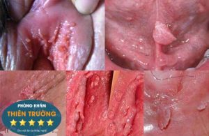 Hình ảnh : sùi mào gà