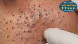 Hình ảnh: Mụn trứng cá.