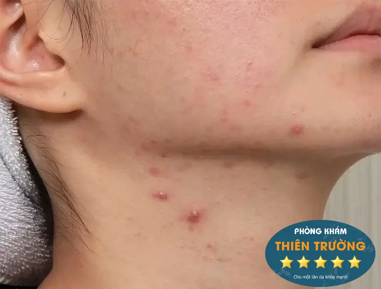 mụn trứng cá ở cổ(3)