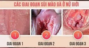 Hình ảnh: sùi mào gà ở nữ giới