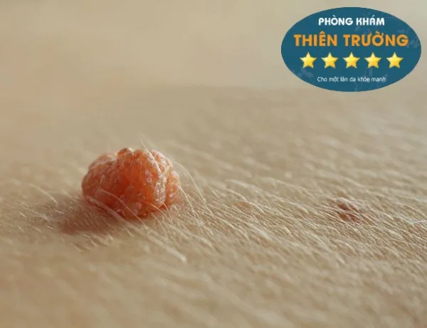 Hình ảnh: Mụn cóc sinh dục.