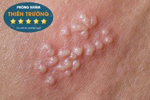 Hình ảnh: Mụn rộp sinh dục.