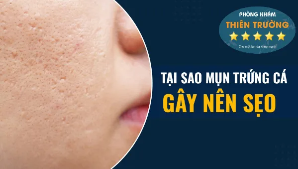 mun-trung-ca-gay-seo-4-1024x579