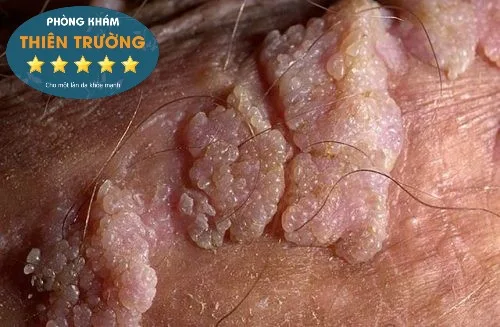 Hình ảnh: Mụn cơm hoa liễu