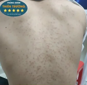 Hình ảnh: Mụn lưng.