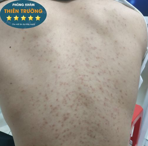 Hình ảnh: Mụn lưng.