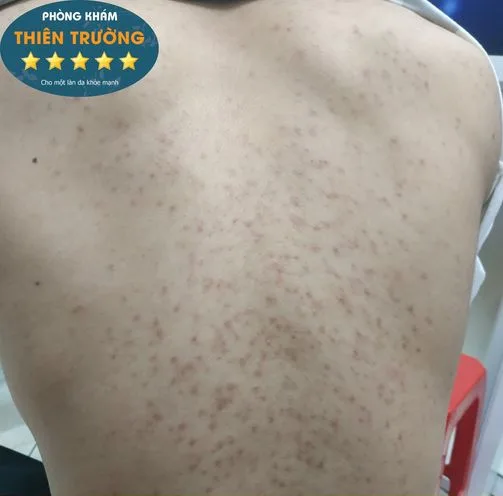 Hình ảnh: Mụn lưng.